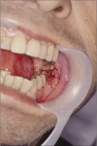 Fig. 4. Gingival and mucosal bleeding control view around mandibular left molars.