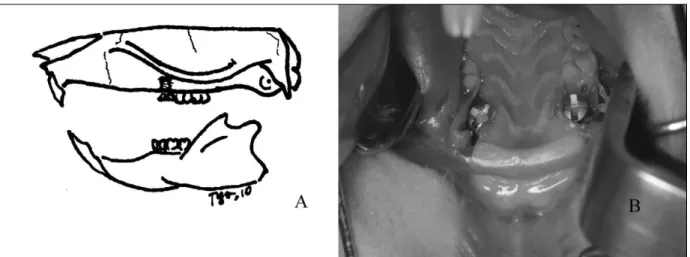 Fig. 1. Schematic design of the experiment A and titanium implants placed in the extraction socket of both maxillary first molars B.