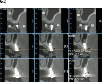 Table 4. Comparison of bone height : pre-OP and post-OP