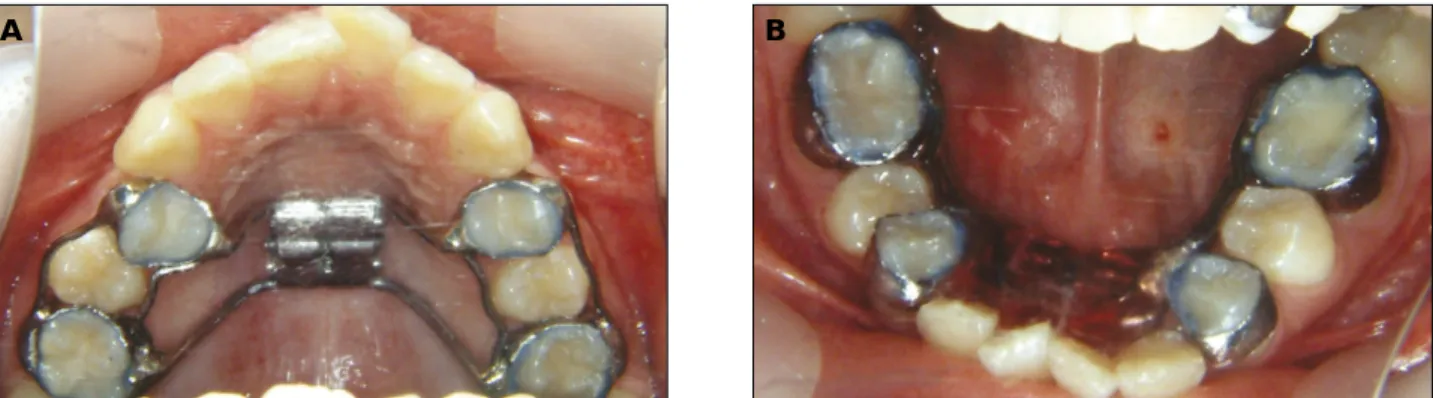 Fig. 3. A, RME (Rapid Maxillary Expansion appliance) in upper jaw; B, Schwarz appliance in lower jaw.