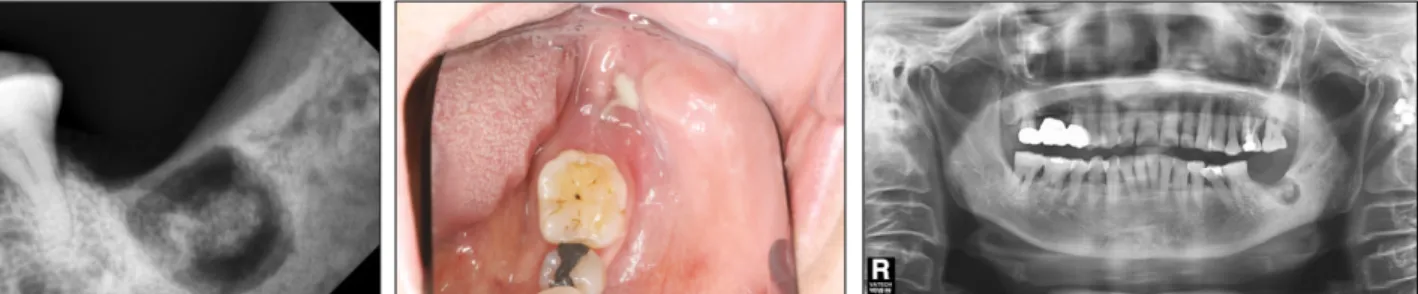 Fig. 2. Periapical view, photograph, and panoramic view; after 8 months of follow up loss.
