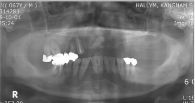 Fig. 1. Pre-operative  panoramic  view.  Multilocular  radiolu- radiolu-cent lesion was seen from right mandibular 2nd premolar to  left  mandibular  1st  premolar