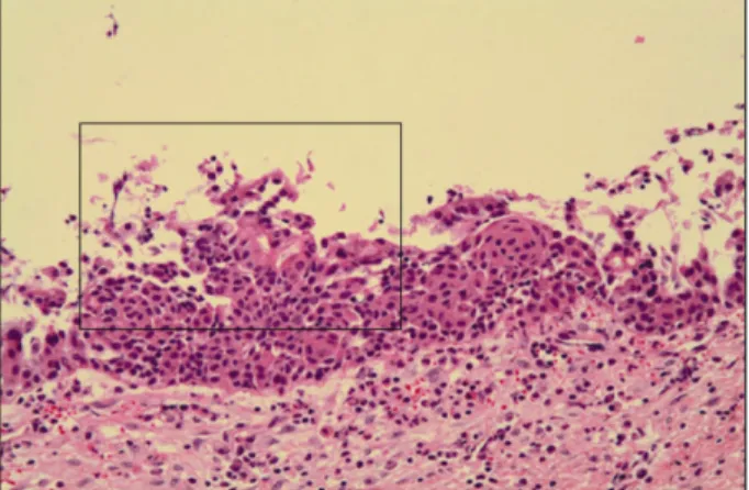 Fig. 7. There was a thin epithelial lining with focal nodular thickening. These thickening often shows swirling  appear-ance of the cells (H&amp;E stain, × 200 magnification).