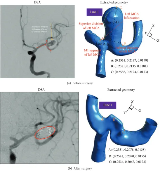 Figure 1: Angiography and extracted pre- and postsurgery cerebral arterial geometries for model 1.