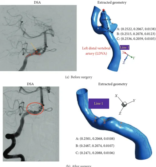 Figure 2: Angiography and extracted pre- and postsurgery cerebral arterial geometries for model 2.