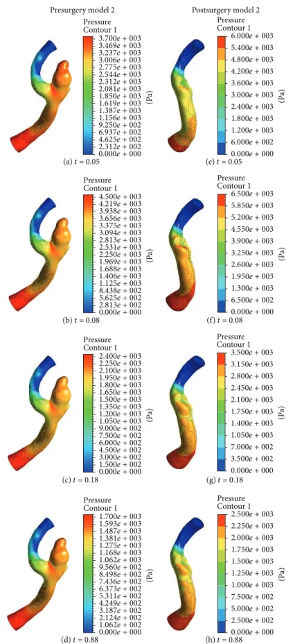 Figure 7: Pressure distribution on geometry model 2 before and after surgery at four different times.