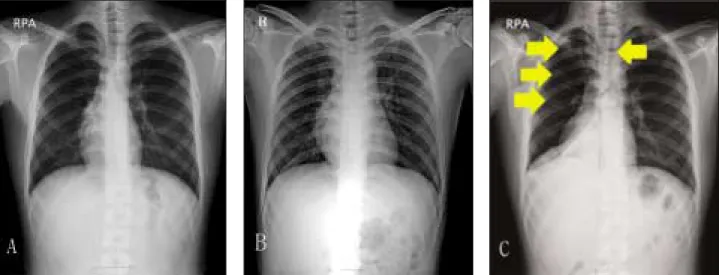 Fig. 2. Non-enhance lung CT. POD #4. Presence of air around trachea.
