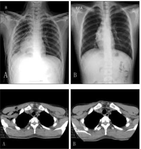 Fig. 3. Chest PA. A, 2 days from tube inser- inser-tion.  Decrease  of  air  around  trachea;  B,  6 days  from  tube  insertion