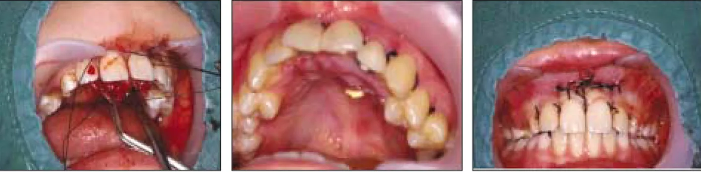 Fig. 3. Labial  wound  drainage  view  by use of rubber strips and iodoform gauze in  the  surgical  extraction  site  of  the impacted mesiodens.