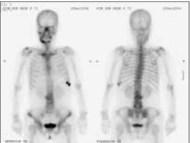 Fig. 2. Preoperative CT showing bony defect. Fig. 3. Preoperative  bone  scan  showing  increased