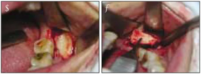 Fig. 2. Vestibular incision for the vertical alveolar ridge aug- aug-mentation and simultaneous maxillary sinus graft.
