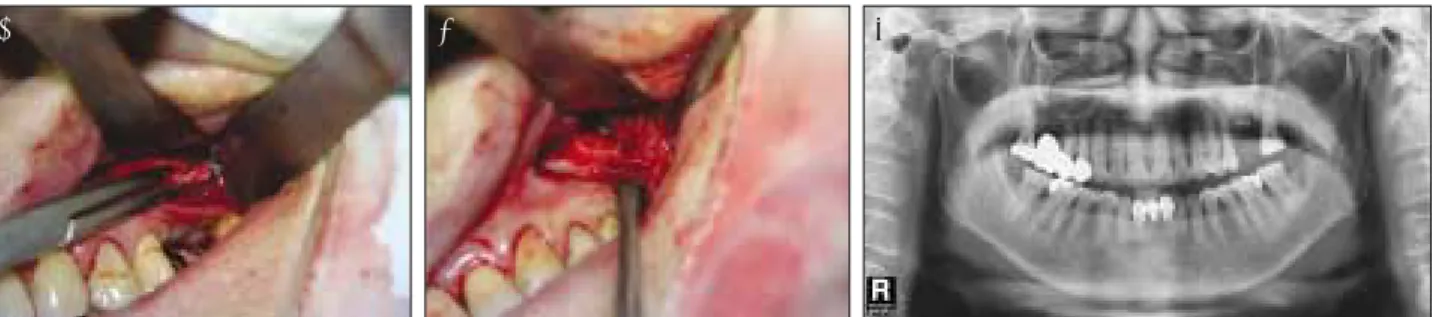 Fig. 4. Vertical alveolar ridge augmentation with mandibular ramal block bone graft.