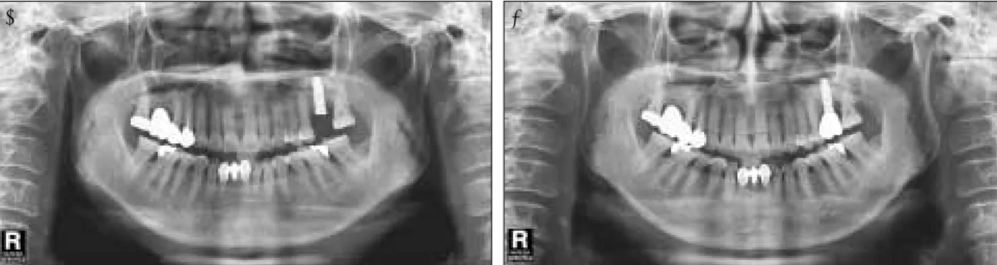 Fig. 5. Installation of the dental implant and follow-up.