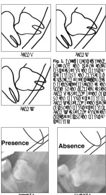 Fig. 1. Vertical  relationship between  the  lower  third molar root and the  mandibu-lar  canal  on  the  panoramic radiograph was classified into 3 categories according to the depth  of  the  impacted  tooth.
