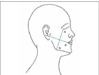 Fig. 1. Postoperative swelling was evaluated by measuring the distance between anatomic landmarks