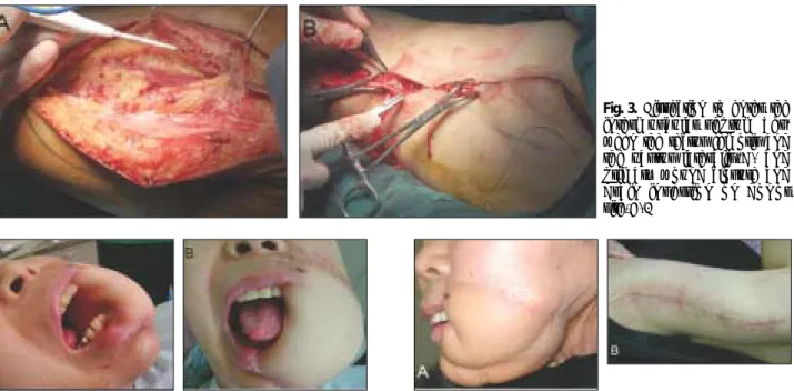 Fig. 3. Dissection  to  enter  the intermuscular  septum   bet-ween the rectus femoris and the  vastus  lateralis(A)  and primary  wound  closure  and drain  insertion  on  donor site(B).