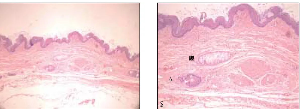 Fig. 5. A : The section shows dermoid appendages are present in the cyst wall, which lined with stratified squamous epithelium