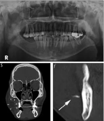 Fig. 2. Postoperative panoramic view. A drain was  placed  into  the masseter  muscle  and the  foreign  body  was removed.