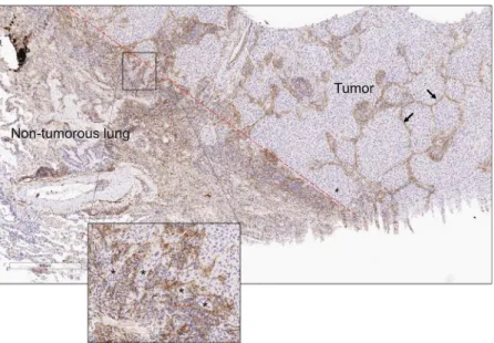 Figure 3.  Thy-1-expressing cells localize within the tumor interstitium and on the tumor periphery
