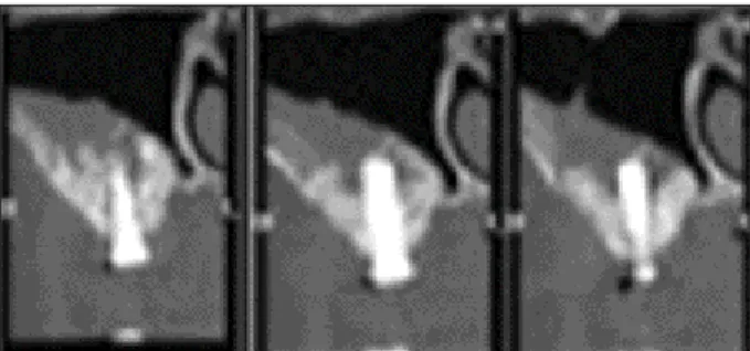 Fig. 1. CT  scan  of  implant  failure  case  due  to  lack  of osseointegration