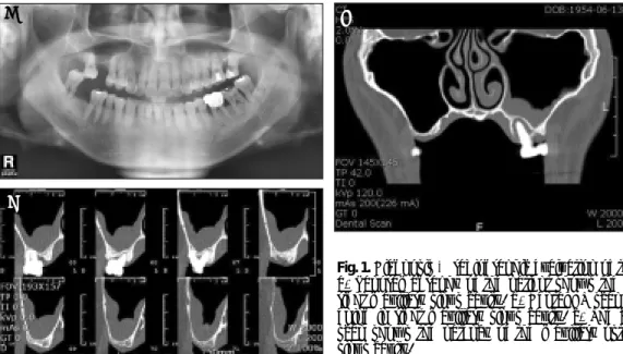 Fig. 1. Diagnosis &amp; radiographic evaluation of the maxillary sinus cavity.