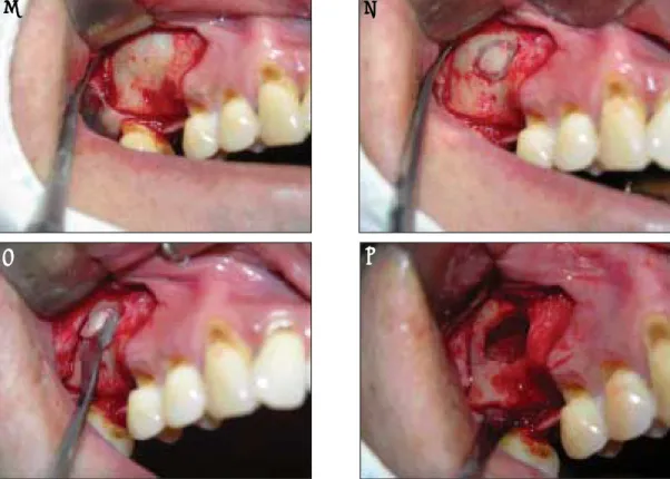 Fig. 2. Lateral window opening on the lateral wall of the right maxillary sinus cavity (missing of 1st molar between premolars and 2nd molar case)  .
