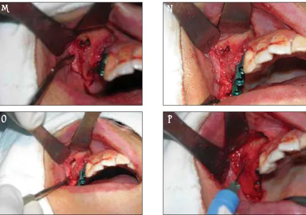 Fig. 5. Maxillary sinus bone graft using paticulated ramal autogenous bone and heterogenic bovin bone(Bio-Oss)