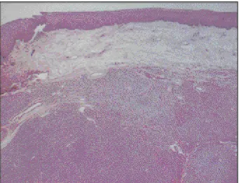 Fig. 7. Focally prominent staghorn vessels, Pericytic pattern, patternless pattern consisting of small fusiform and spindled cells.(HE, ×40)