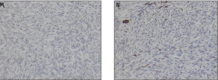 Fig. 10. IHC microphotographs of SFT. A. Negative reaction to S-100. B. Negative reaction to SMA.