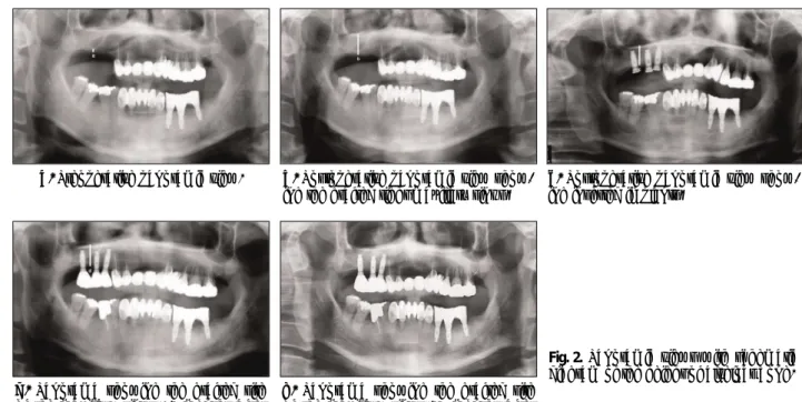 Fig. 2. Panoramic views with schematic diagram of the height of alveloar bone.