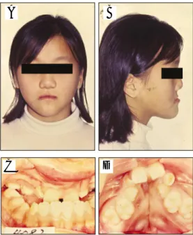 Fig. 1. 11-year-old female with BCLP at first visit;