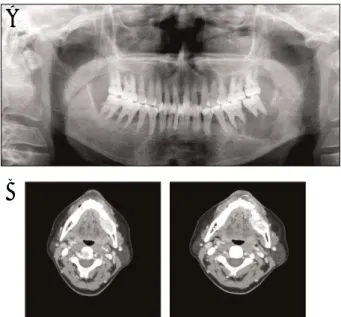 Fig. 1 Intraoral view at initial examination showing hard and palpatable swelling.