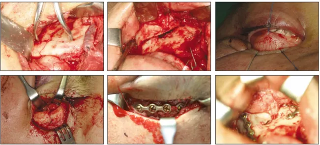 Fig. 3. Surgical procedures; mandibular fracture : submandibular approach, Lefort I fracture : vestibular approach, both ZMC frqcture : transconjunctival approach and lateral eyebrow approach(영어 어법에 맞게 문장으로 고치세요, 단어 의 나열은 곤란함)