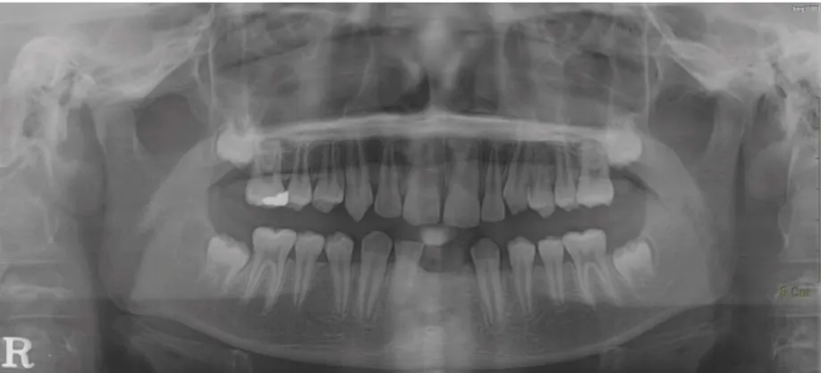 Fig. 7.  3years Post-operative panoramic view; There is no evidence of recurrence.