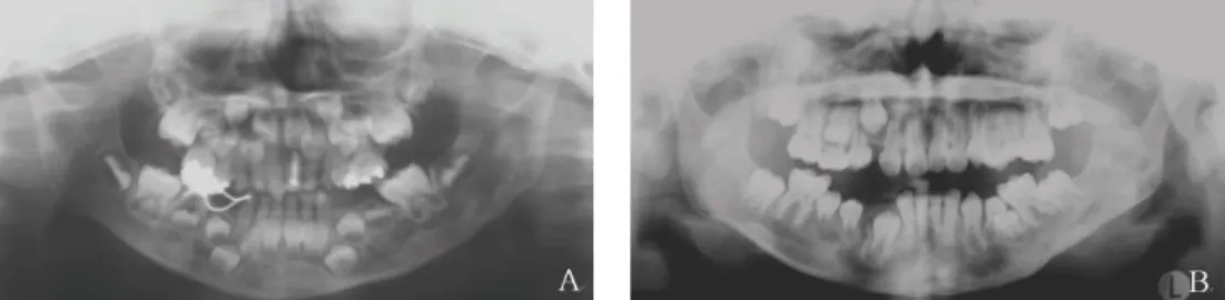 Fig. 9 .  A. Panoramic view at the first medical examination, B. 5years post-operative panoramic view at the operation