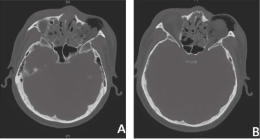 Fig. 2. Extraoral intubation was performed with blunt dissection during intraorally intubated state.