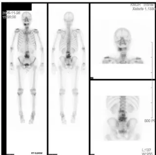Fig. 1. Bone scan - increased uptake on right mandible and multiple osseous metastasis.