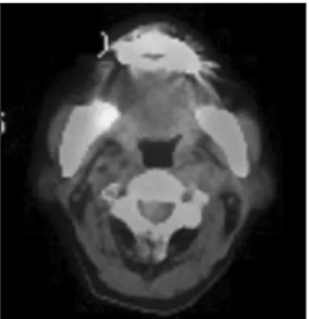 Fig. 4. Histologic feature (×100) showing irregular bony margins and empty lacunae due to absence of  osteo-cyte.