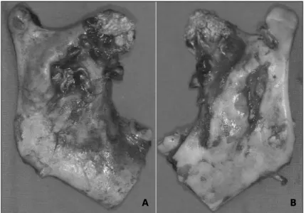 Fig. 2. Specimen showing bucco-lingual expainsion with thinning of the cortical bone. Notice the focal perforation of ramal and coronoid process areas.