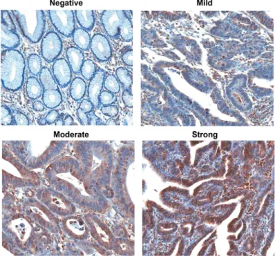 Figure 2: Immunohistochemical detection of ADCY3 expression in normal and non-neoplastic gastric mucosal glands  and  gastric  carcinomas  (magnification  200x)