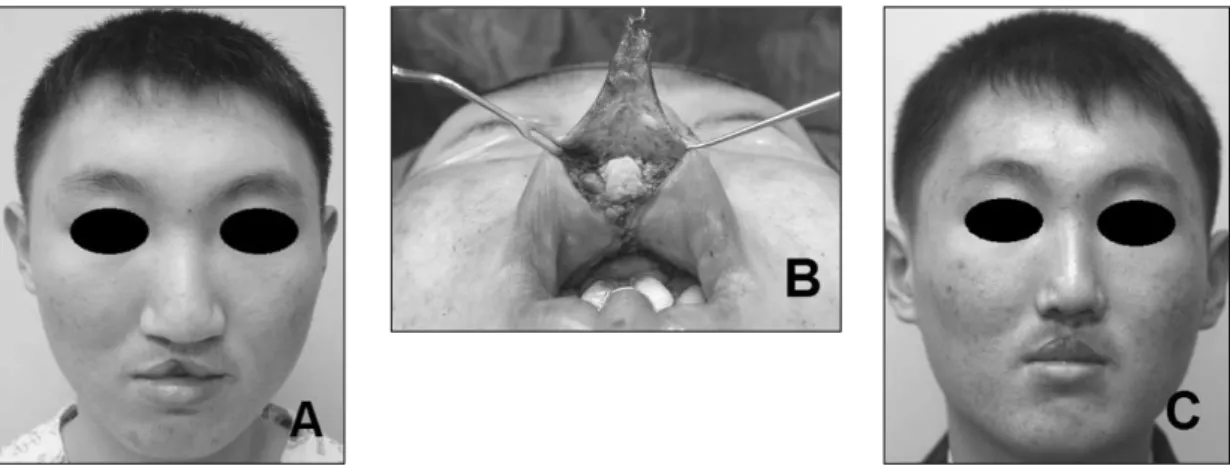 Fig. 10.  Preoperative (A), intraoperative (B), and 6-month postoperative (C) photographs showing the augmentation of the defi- defi-cient the central part of the upper lip using the V-Y advancement and the AlloDerm � graft, and the correction of the cleft