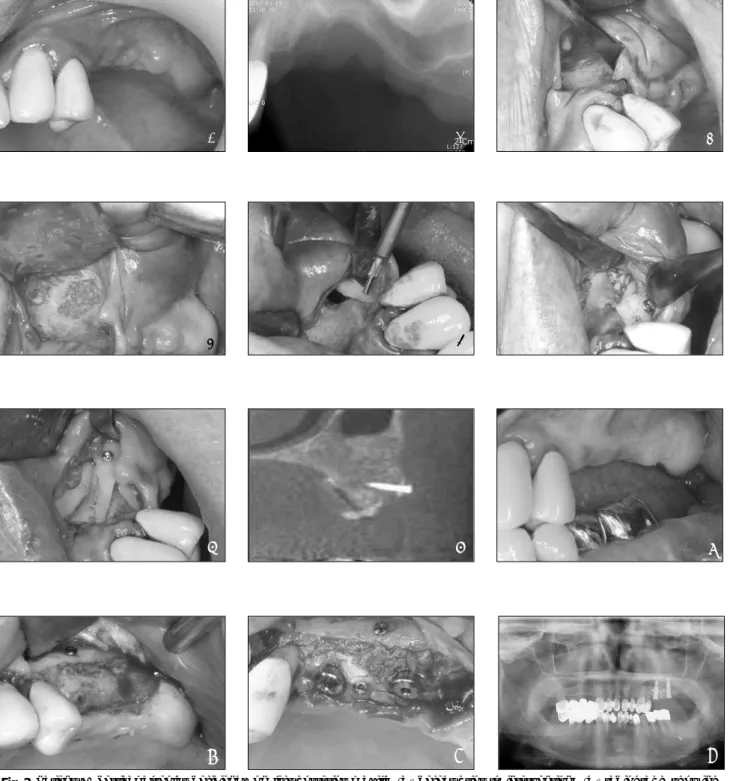 Fig. 2.  Patient 2, Vertical alveolar deficiency on left posterior maxilla (a) defect prior to intervention; (b) radiograph showing severe alveolar and sinus bone deficiency; (c) vertical incision and dissection with tunnelling action; (d) sinus bone graft