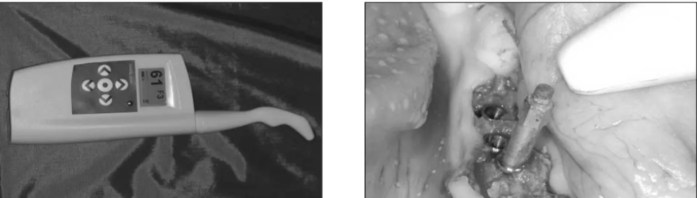 Fig. 6. Osstell TM mentor (Integration Diagnostic Ltd., Sweden).