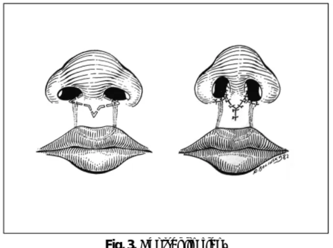 Fig. 3. Central lip flap.
