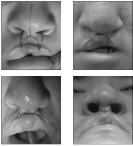 Fig. 7. The patient who showed the necrosis of the forked flap.