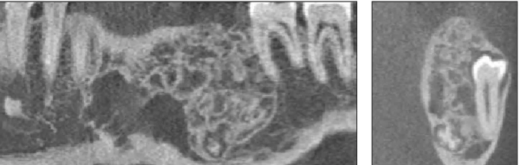 Fig. 2. Dental CT at pre-operation. Note the large, irregular, radiolucent &amp; radio-opaque mass