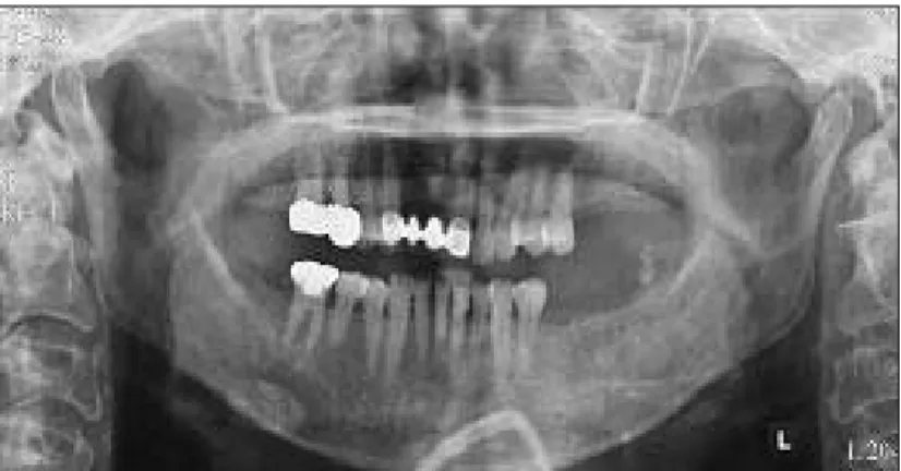 Fig. 2. Well-defined  unilocular  radiolucent  lesion  at  the  anterior  maxilla seen in the panoramic radiograph.