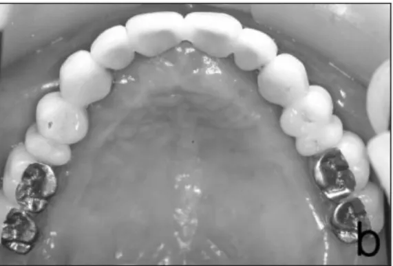 Fig. 6. The completed final prosthodontic restorations.