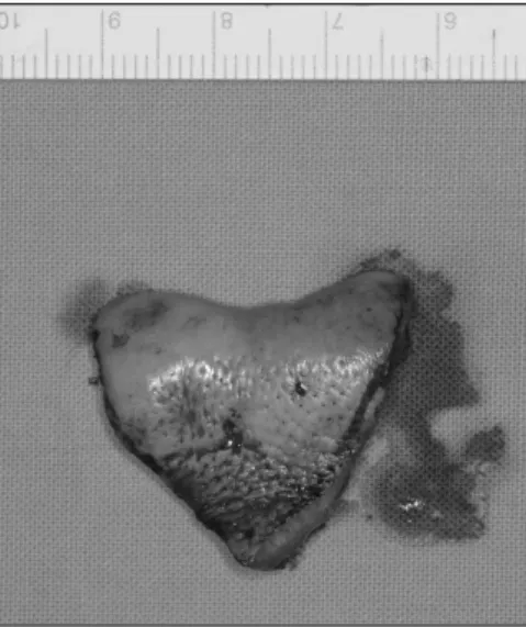 Fig. 7. The  bridge  pedicle  providing  blood  supply form the upper lip.