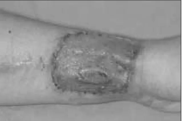 Fig. 1. Exposure of flexor tendon and irregular texture due to scar contraction.